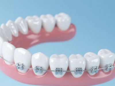 想做牙齒矯正，哪種方案更適合你？
