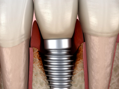 種植牙的術(shù)前準(zhǔn)備有哪些？