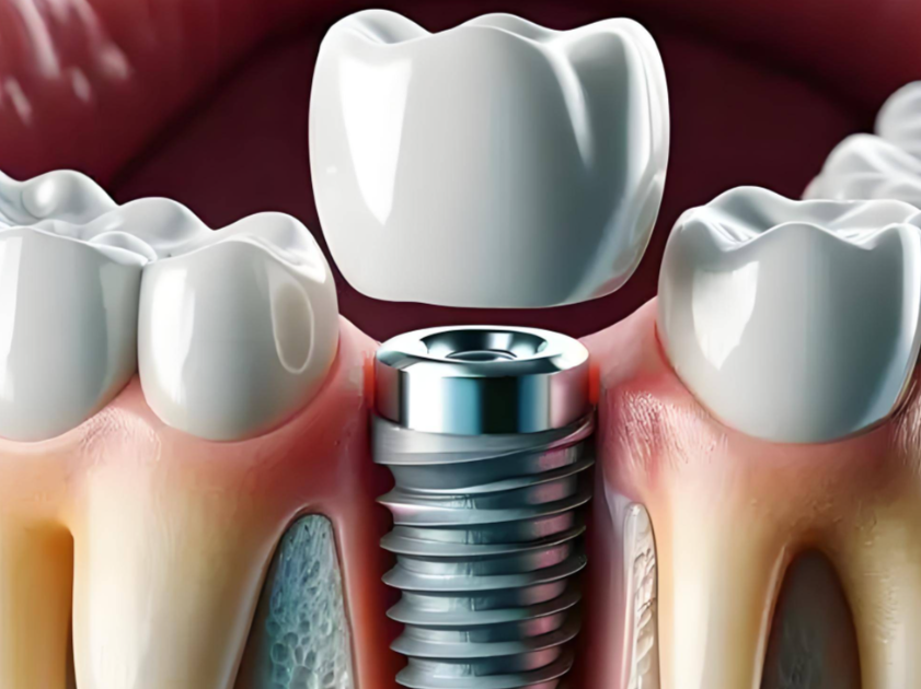 對于老年人來說，裝假牙和種植牙哪個更好